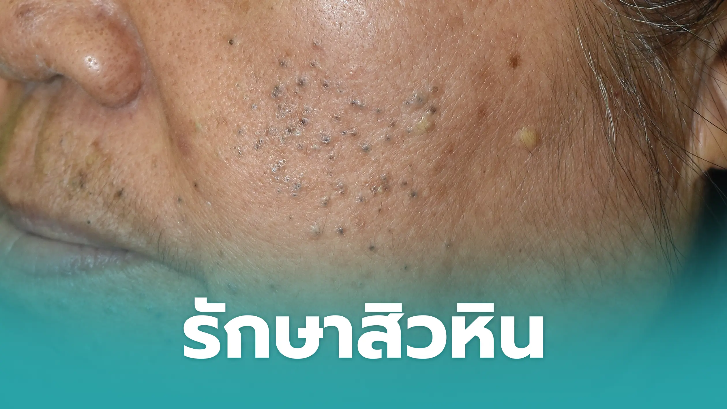 รักษาสิวหิน รักษาสิวหิน