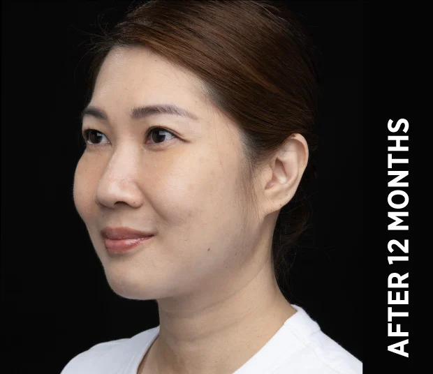 ba-face3-after-12months
