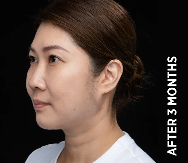 ba-face3-after-3months