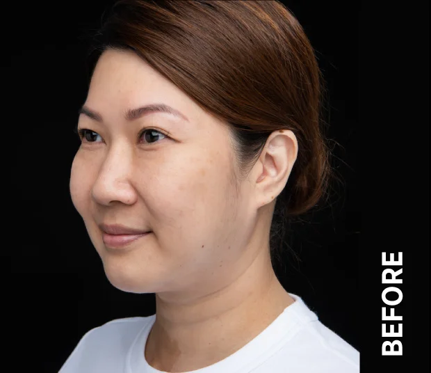 ba-face3-before