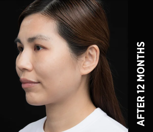 ba-face5-after-12months