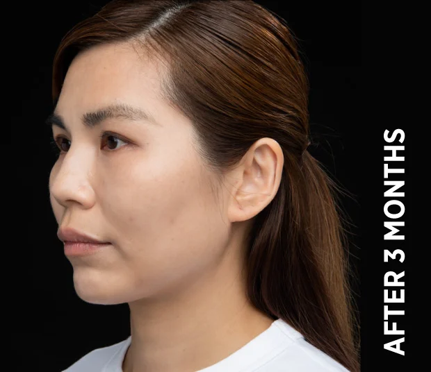 ba-face5-after-3months