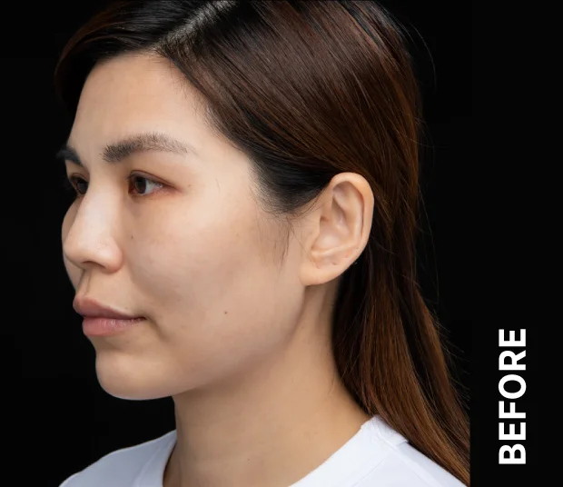 ba-face5-before