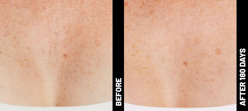 blinder-debbie-decolletage-after-180
