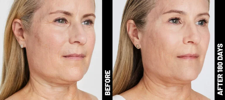 blinder-debbie-face-after-180-768x344