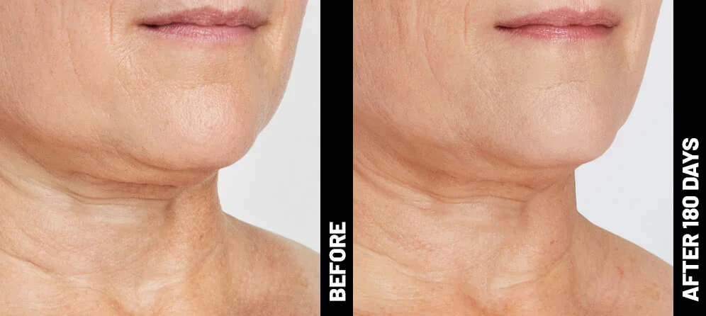 blinder-debbie-neck-after-180