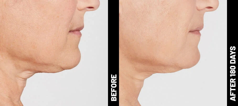 blinder-debbie-profile-after-180