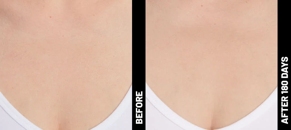 blinder-grace-decolletage-after-180 (1)