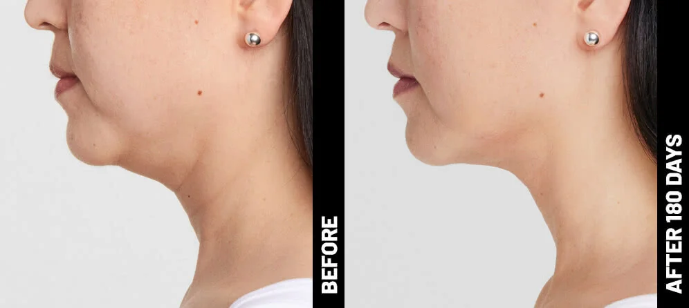 blinder-grace-profile-after-180