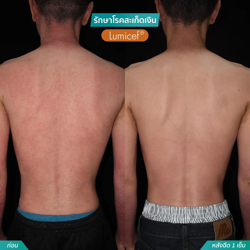 รักษาโรคสะเก็ดเงินด้วยวิธีฉีดยา_หลังฉีดScapho1เข็ม-07-1024x1024 (1)