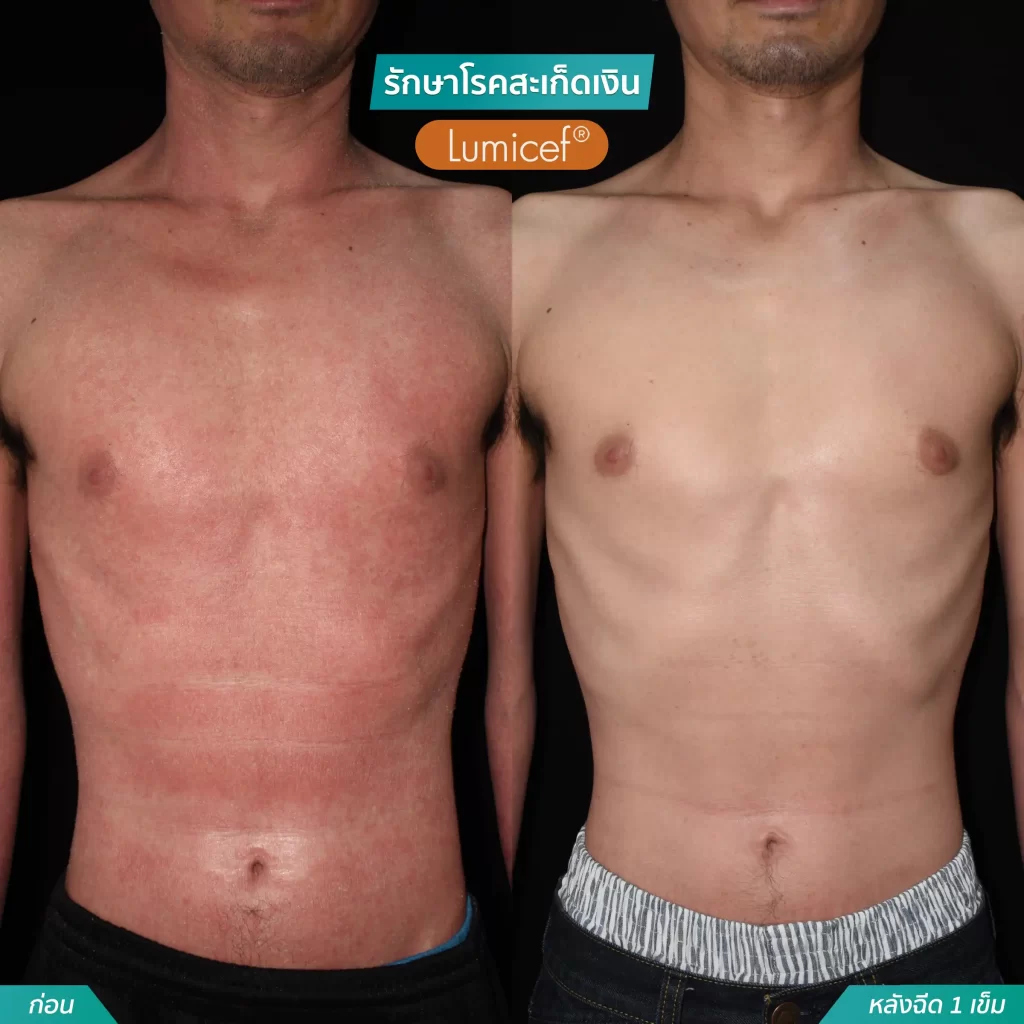 รักษาโรคสะเก็ดเงินด้วยวิธีฉีดยา_หลังฉีดScapho1เข็ม-08-1024x1024