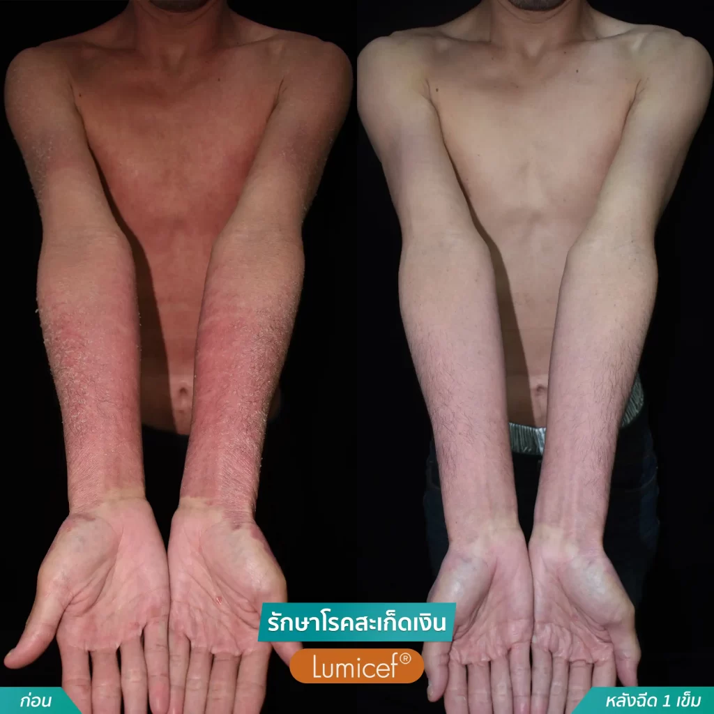รักษาโรคสะเก็ดเงินด้วยวิธีฉีดยา_หลังฉีดScapho1เข็ม-09-1024x1024