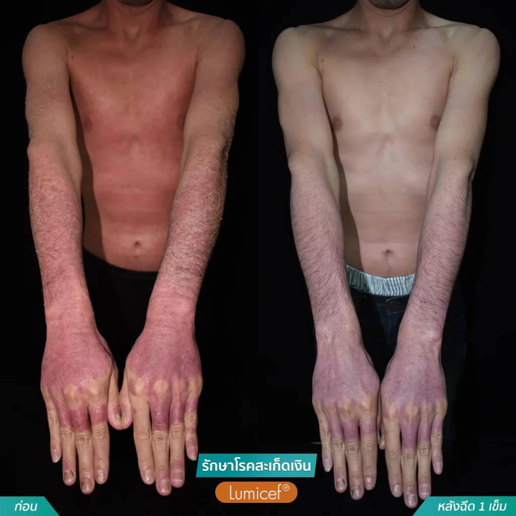 รักษาโรคสะเก็ดเงินด้วยวิธีฉีดยา_หลังฉีดScapho1เข็ม-10-1024x1024