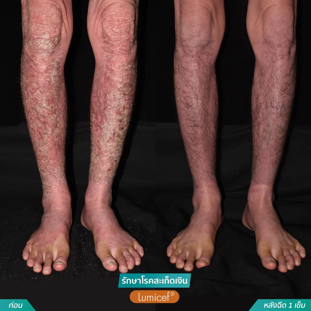 รักษาโรคสะเก็ดเงินด้วยวิธีฉีดยา_หลังฉีดScapho1เข็ม-11-1024x1024