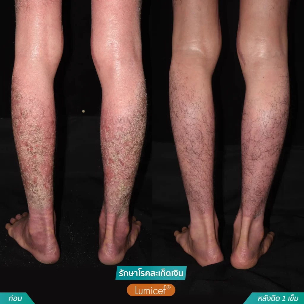 รักษาโรคสะเก็ดเงินด้วยวิธีฉีดยา_หลังฉีดScapho1เข็ม-12-1024x1024