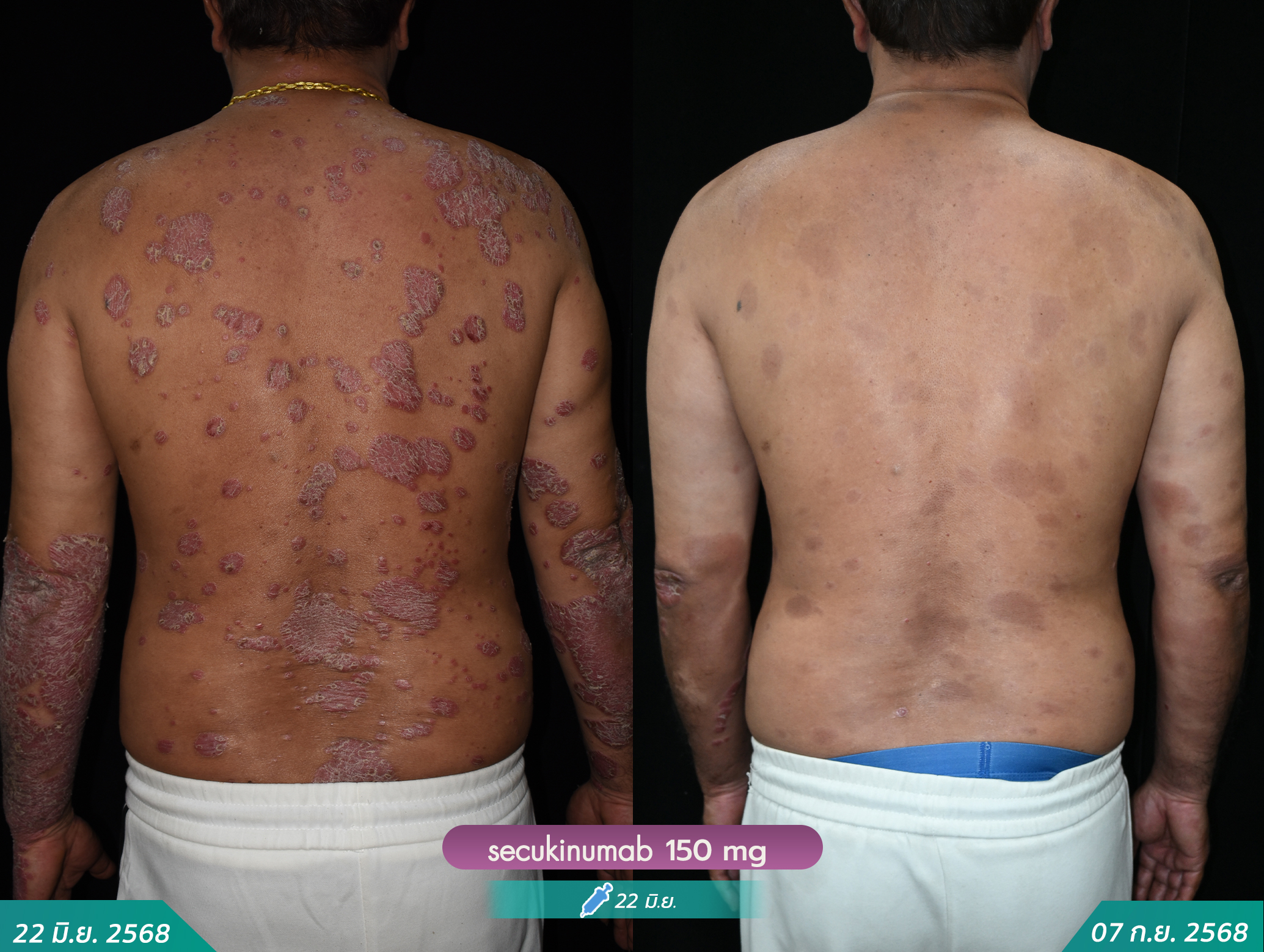 6806332-พิโชติ-พรจิตติเวชรี-secukinumab-หลังฉีด-7กย-เข็ม17