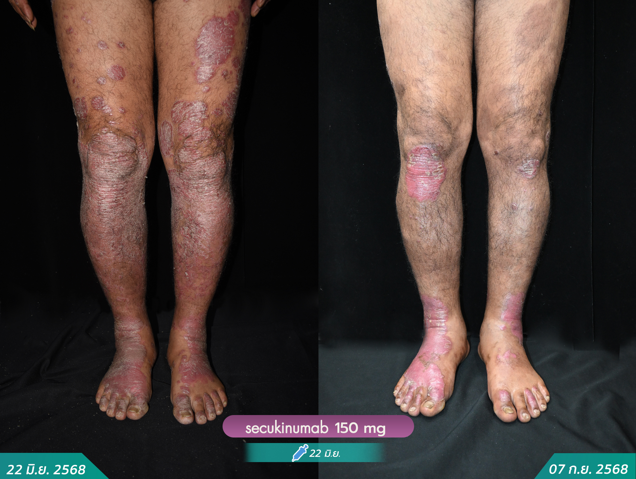 6806332-พิโชติ-พรจิตติเวชรี-secukinumab-หลังฉีด-7กย-เข็ม18