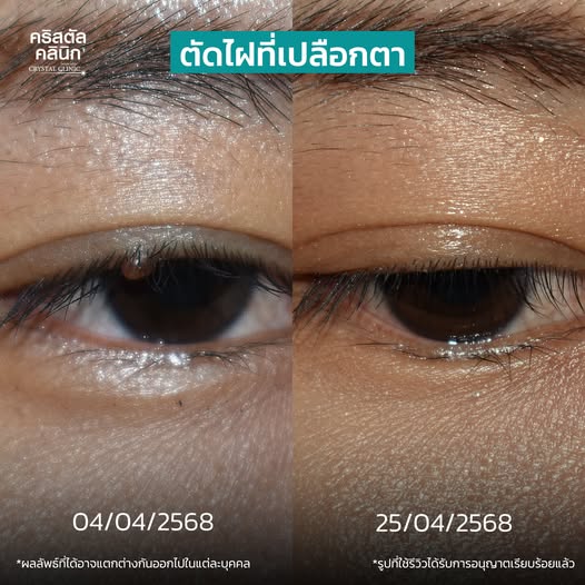 ผ่าตัดไฝที่เปลือกตา 1