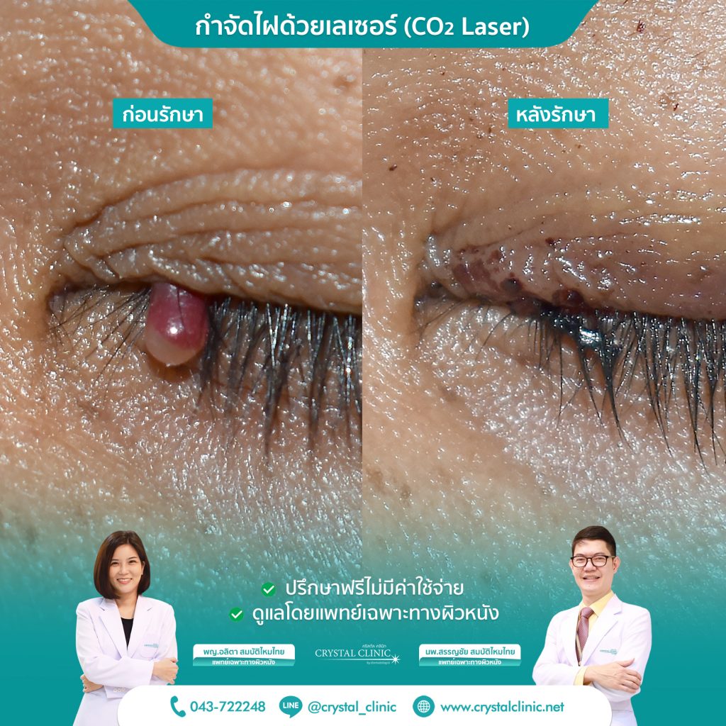 ผ่าตัดไฝที่เปลือกตา 2