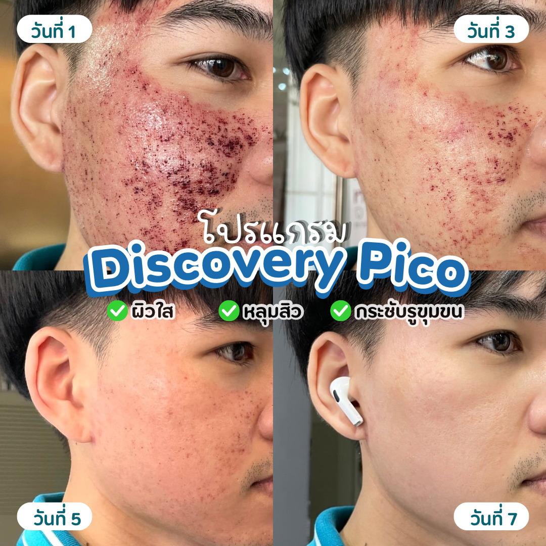 หลังทำ Pico Deep หลุมสิว ผิวเรียบเนียน กระชับรูขุมขน Discovery Pico Laser