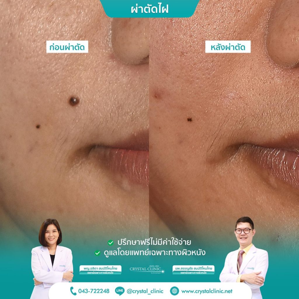 เลเซอร์ไฝ 1