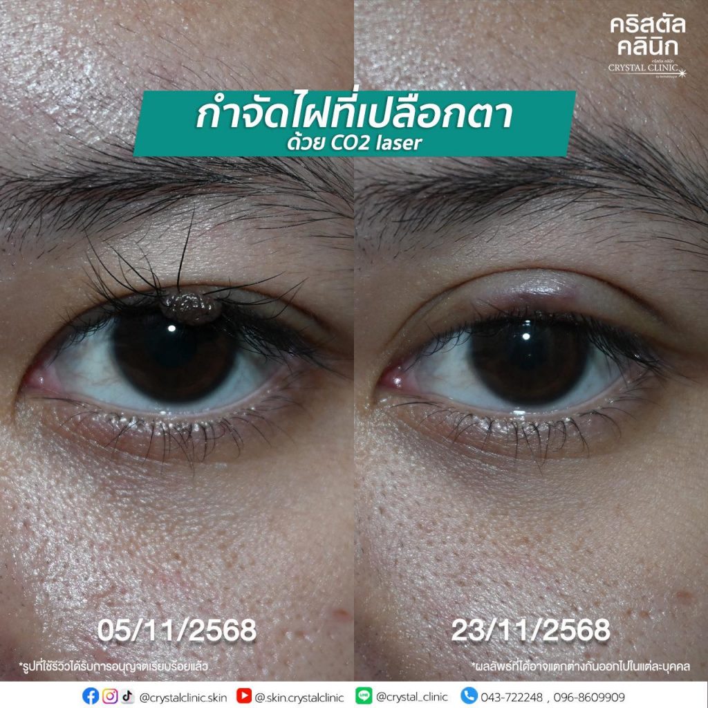 เลเซอร์ไฝที่เปลือกตา
