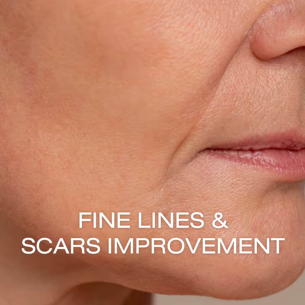 Fine Lines & Scars Improvement