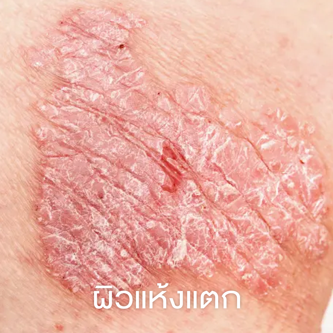 ผิวแห้งแตก