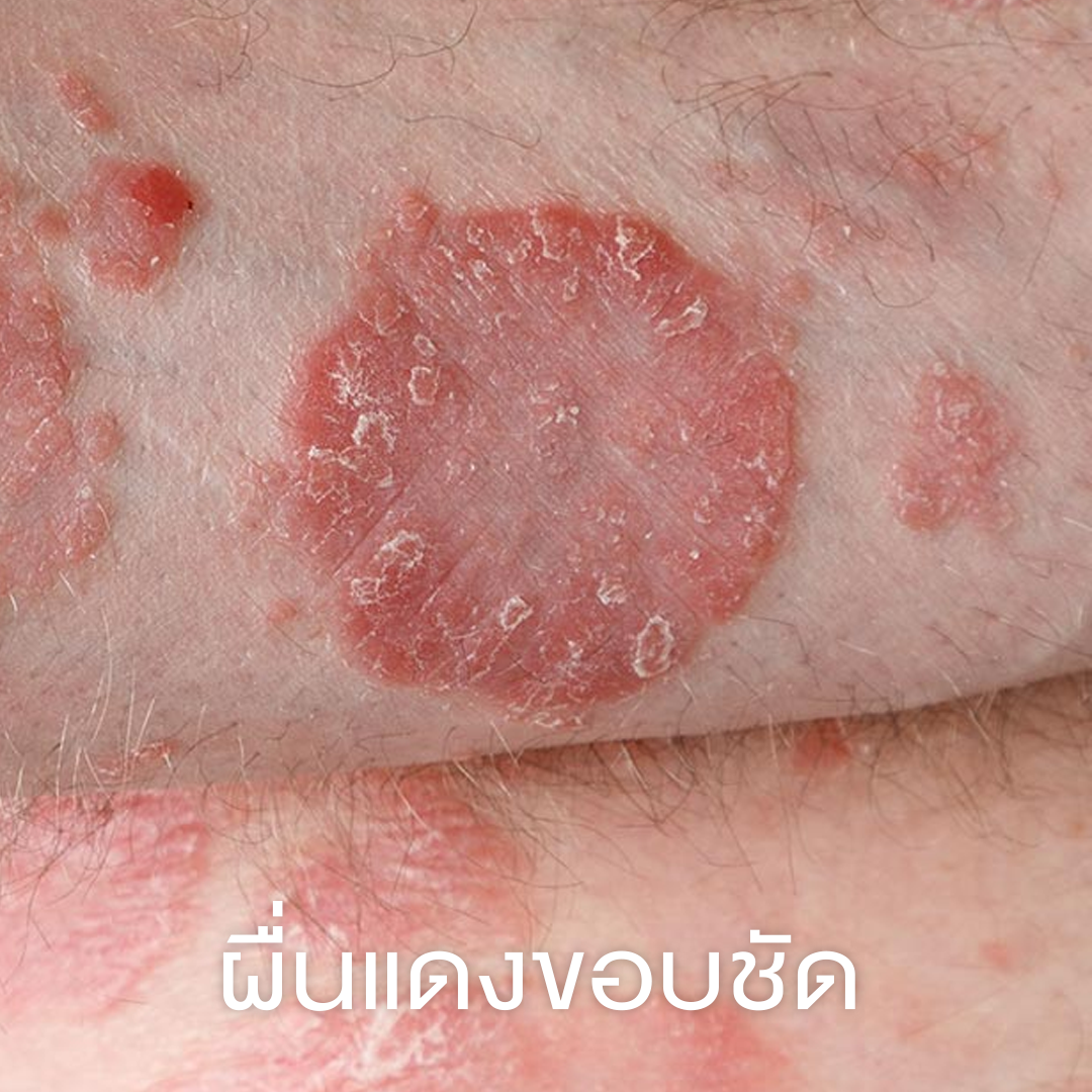 ผื่นแดงขอบชัด
