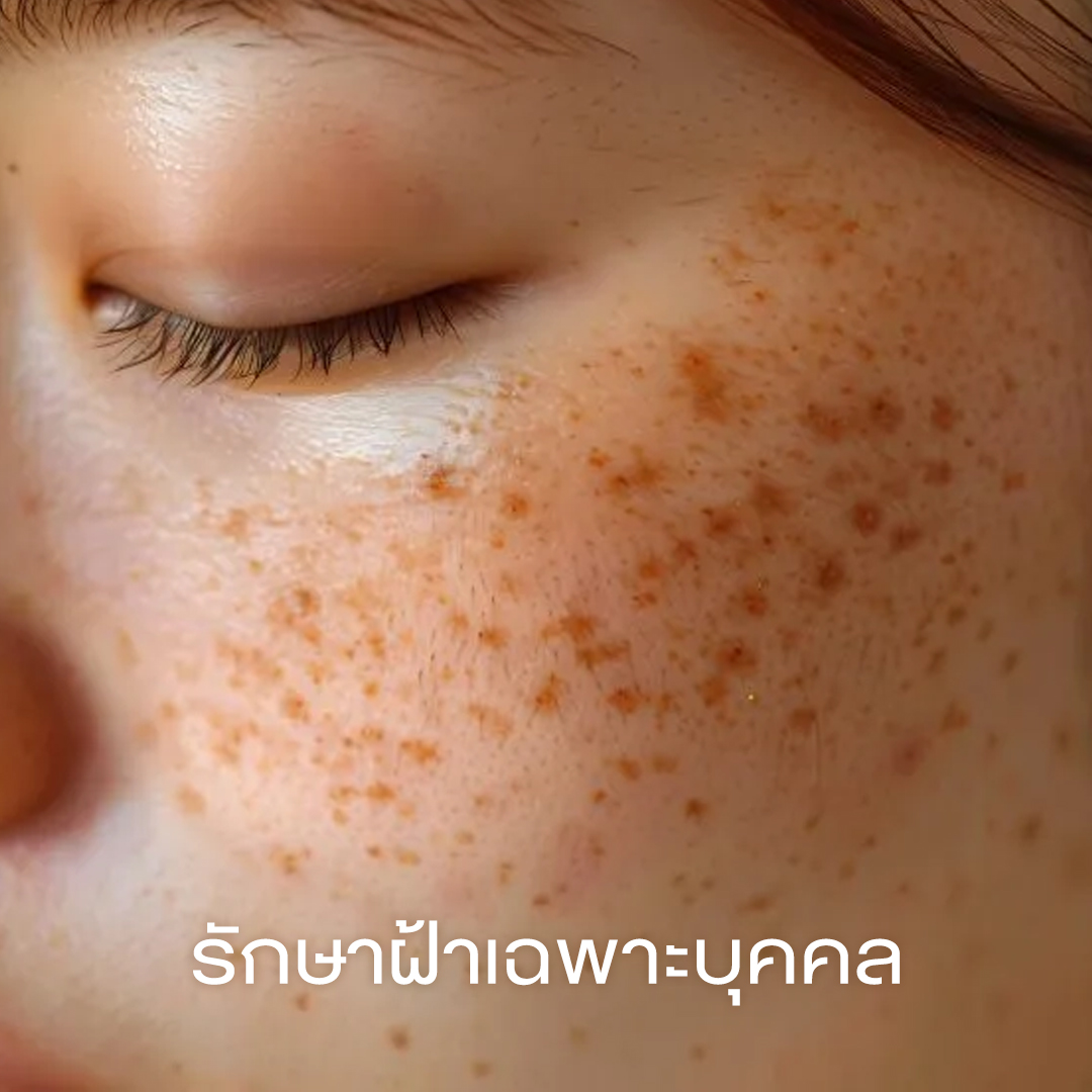 รักษาฝ้าเฉพาะบุคคล คริสตัลคลินิก มหาสารคาม