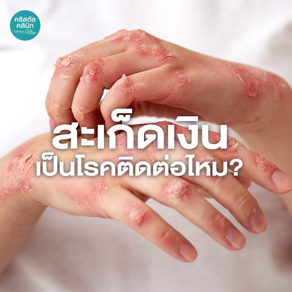 สะเก็ดเงิน เป็นโรคติดต่อไหม