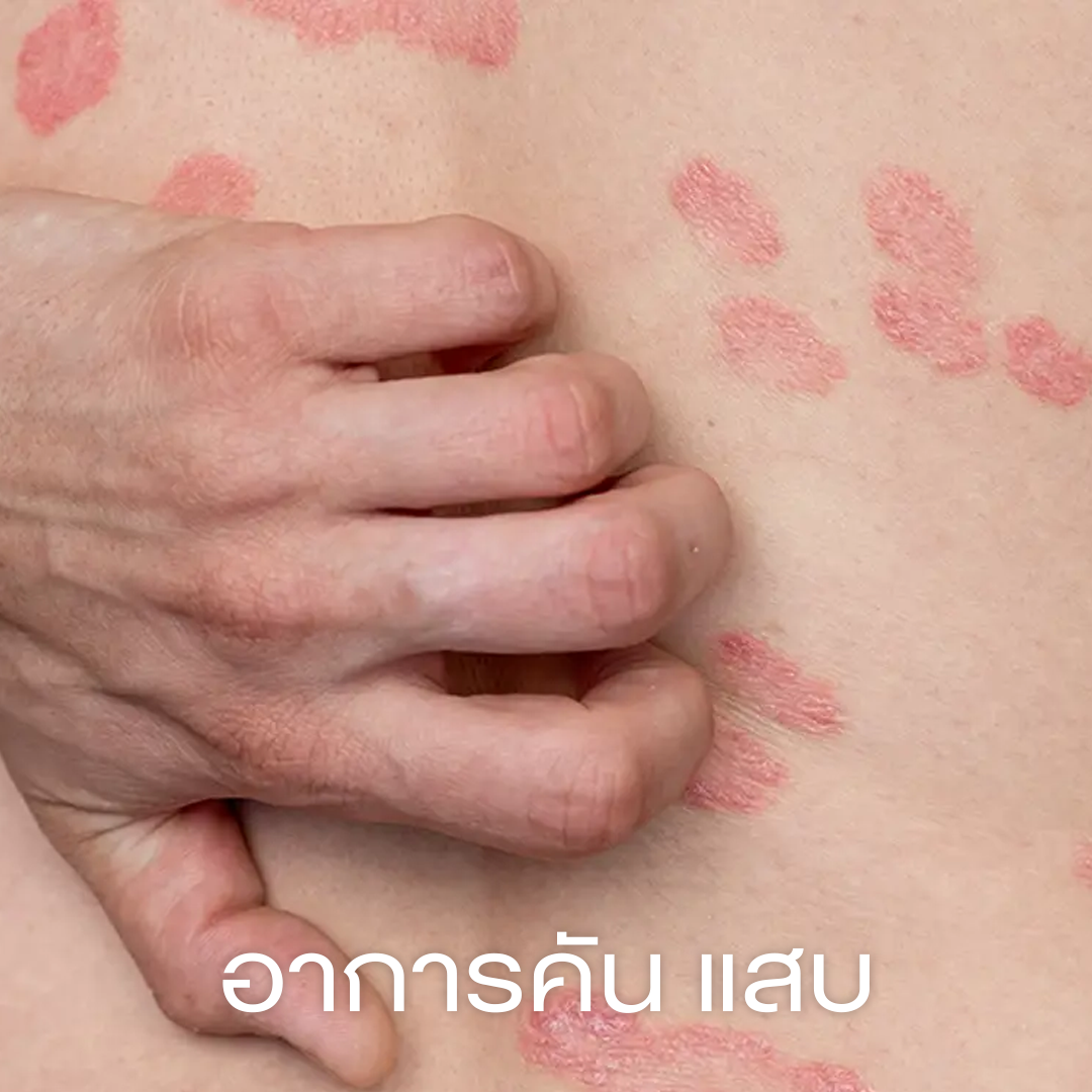 อาการคันหรือแสบ