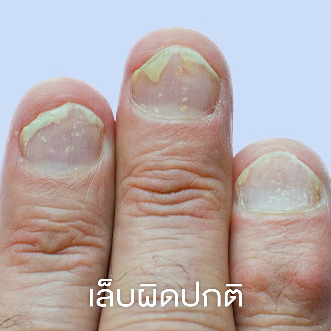 เล็บผิดปกติ
