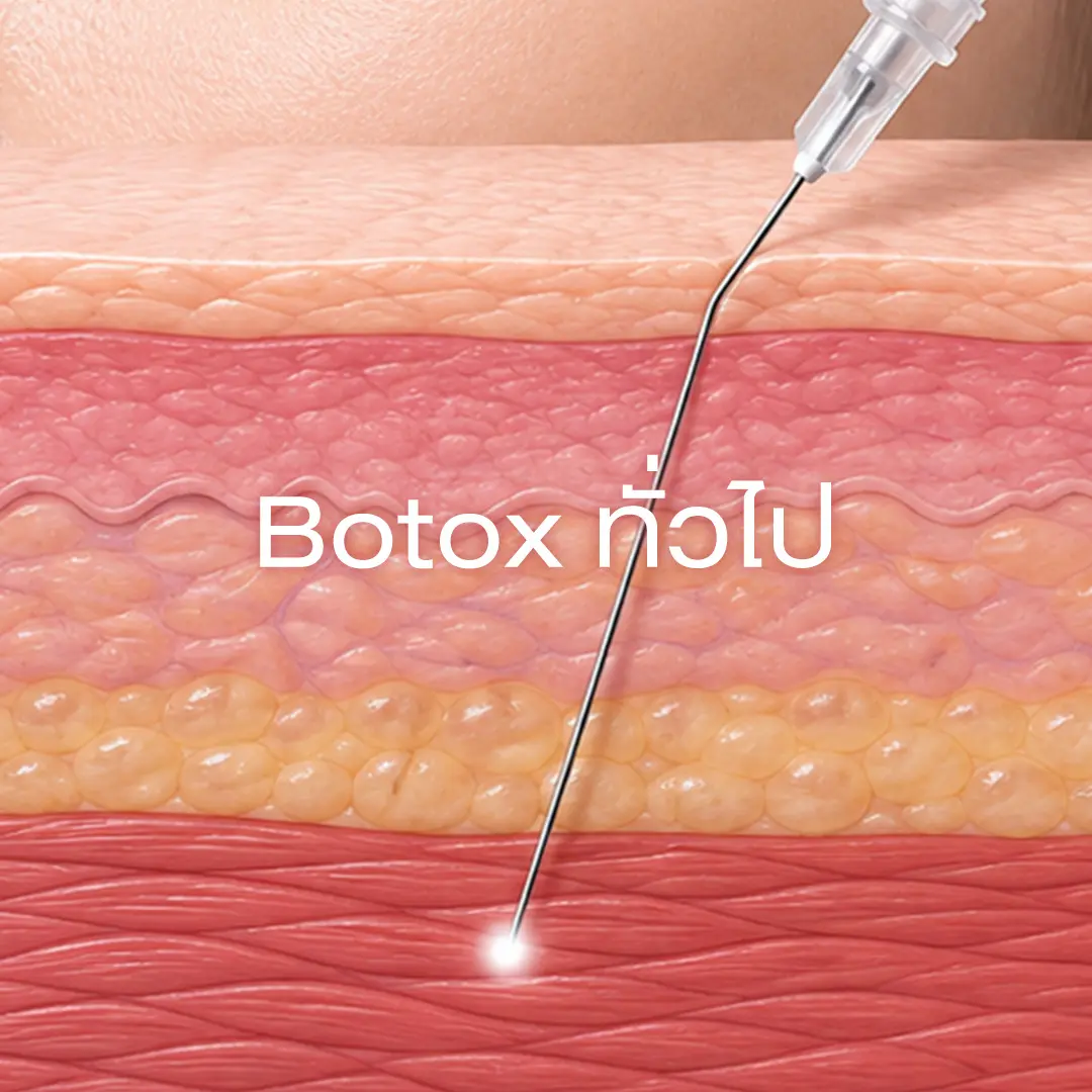 Botox ทั่วไป