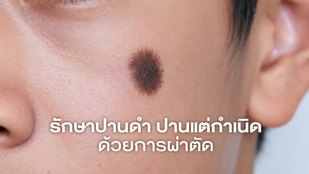 Cover รักษาปานดำปานแต่กำเนิดด้วยการผ่าตัด