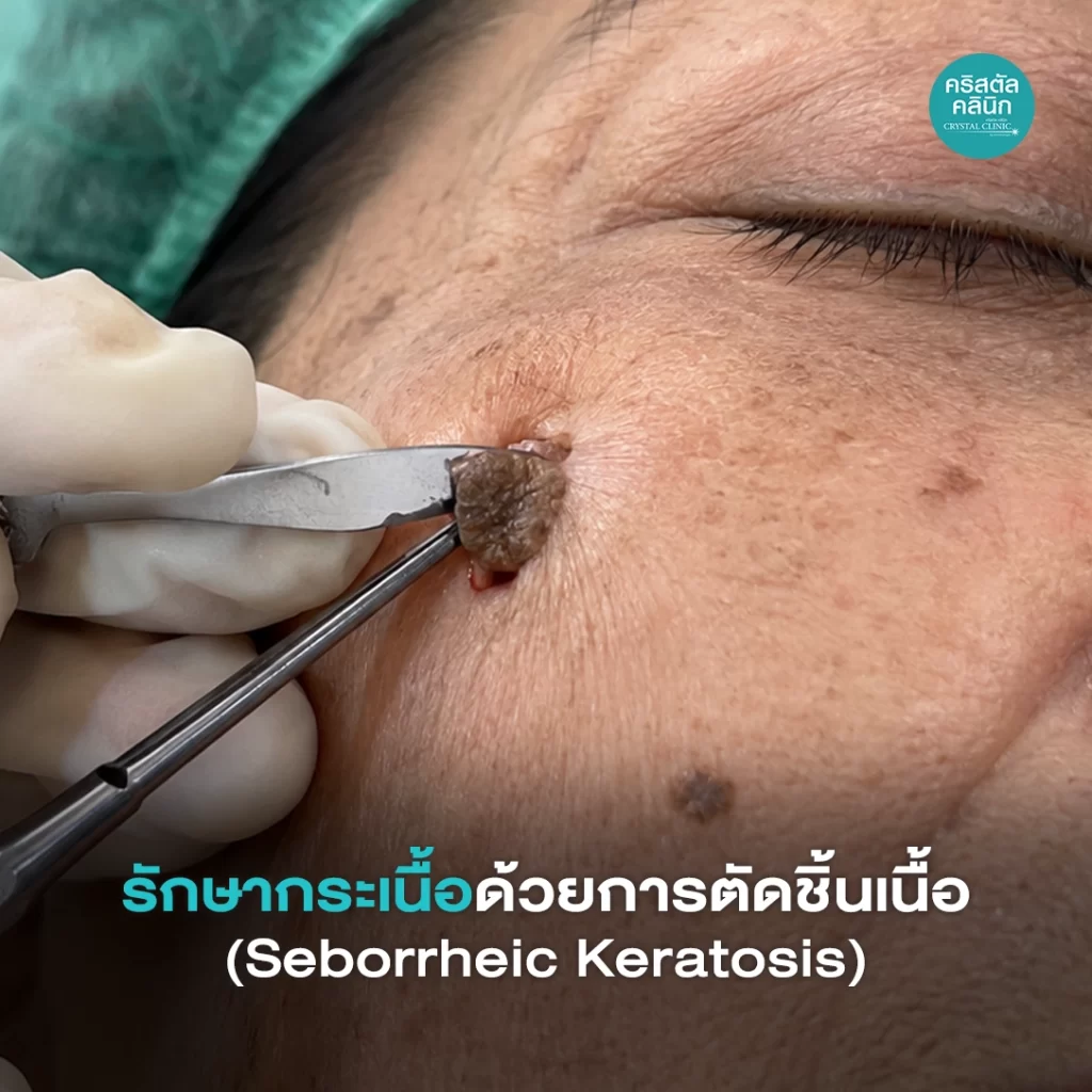 รักษากระเนื้อด้วยการตัดชิ้นเนื้อ-Seborrheic-Keratosis