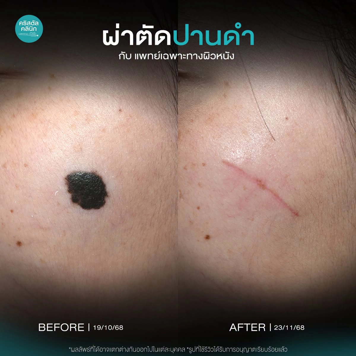 รักษาปานดำ ปานแต่กำเนิด ผ่าตัดปานดำ