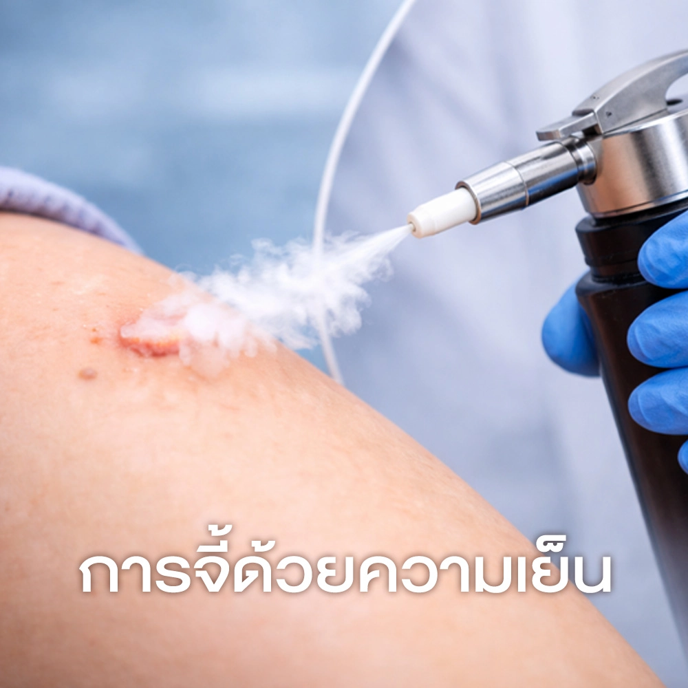 2. การจี้ด้วยความเย็น (Cryotherapy _ Liquid Nitrogen)
