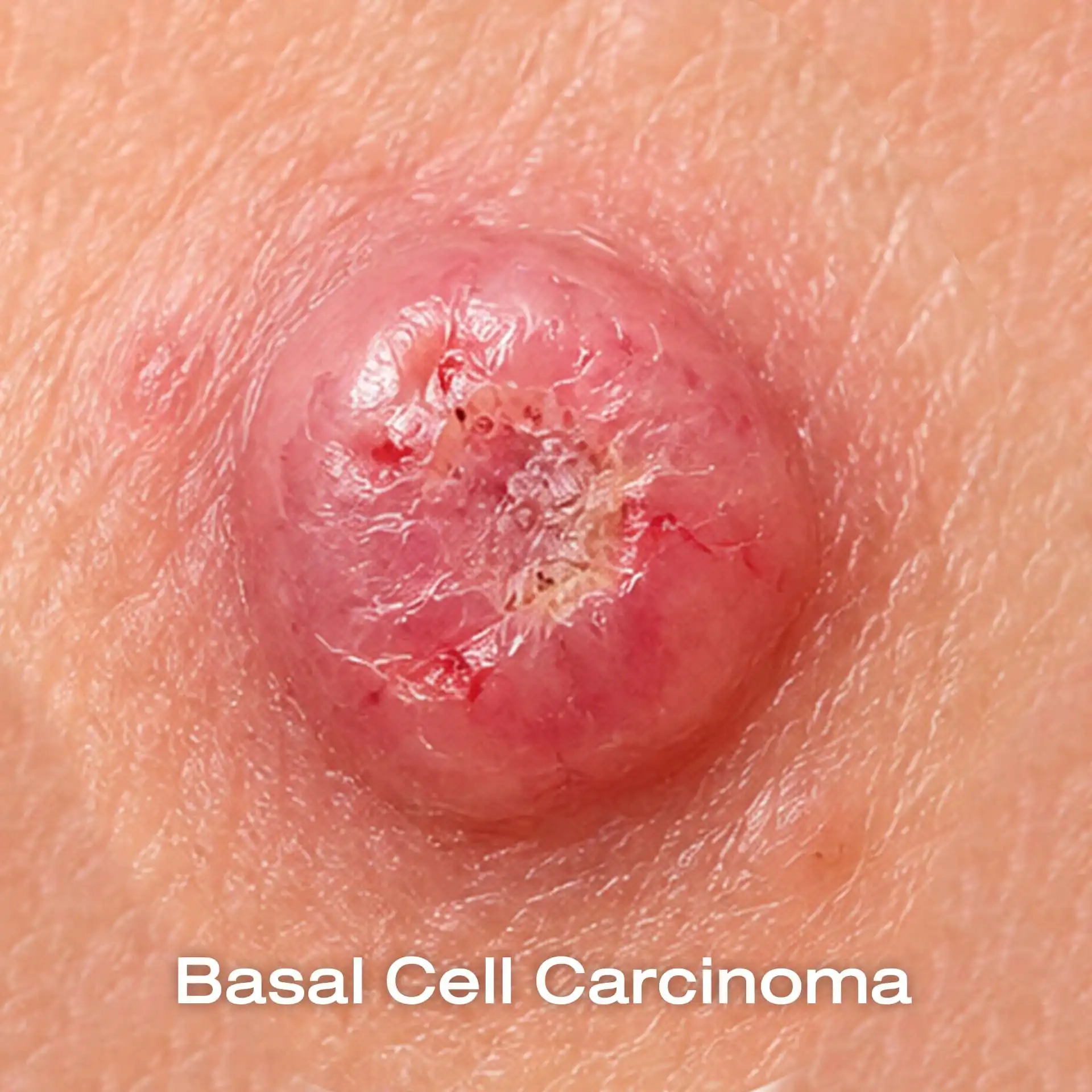 Basal Cell Carcinoma (BCC)