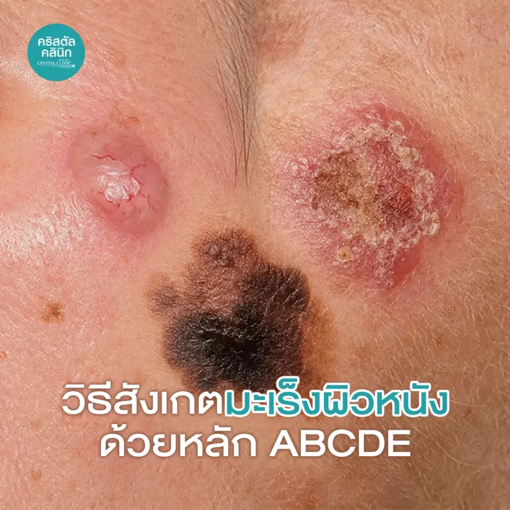 Cover วิธีสังเกตมะเร็วผิวหนัง