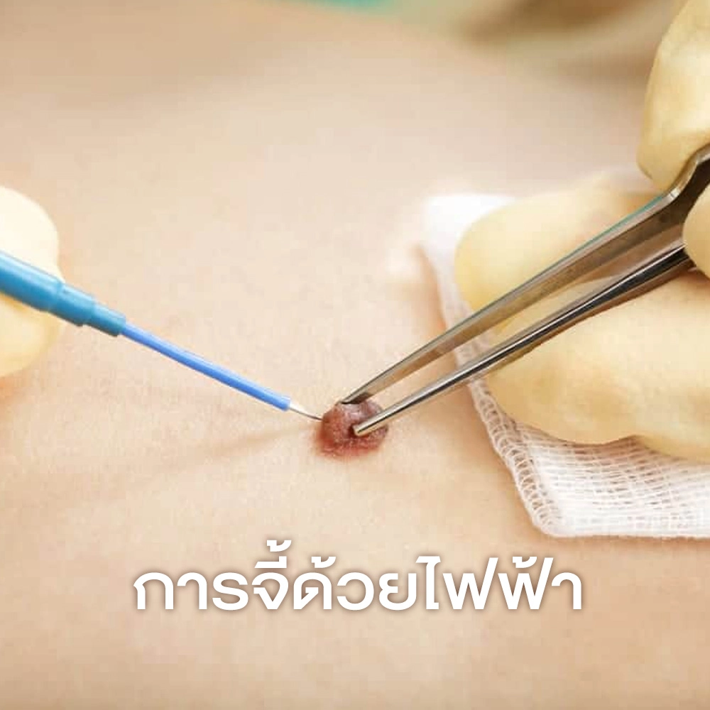 การจี้ด้วยไฟฟ้า (Electrosurgery _ Electrocautery)