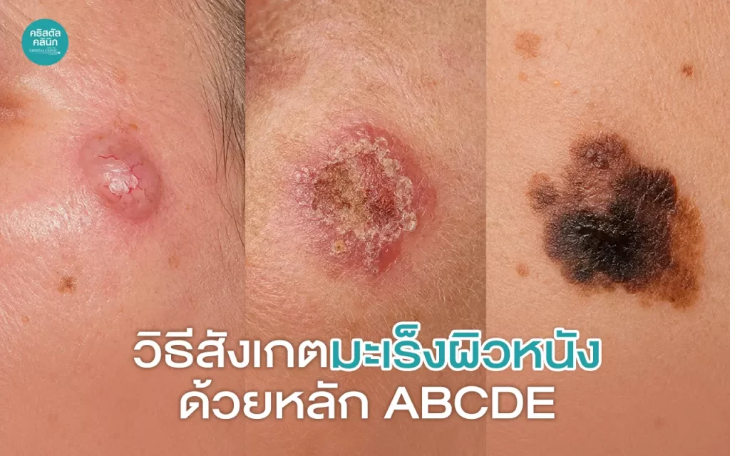 วิธีสังเกตมะเร็งผิวหนังด้วยหลัก ABCDE