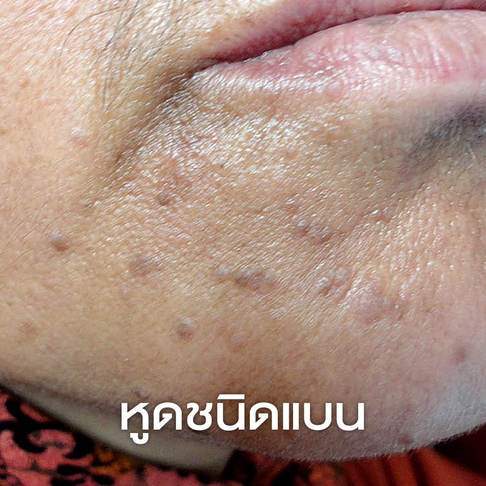 หูดชนิดแบน (Flat Warts _ Verruca Plana)