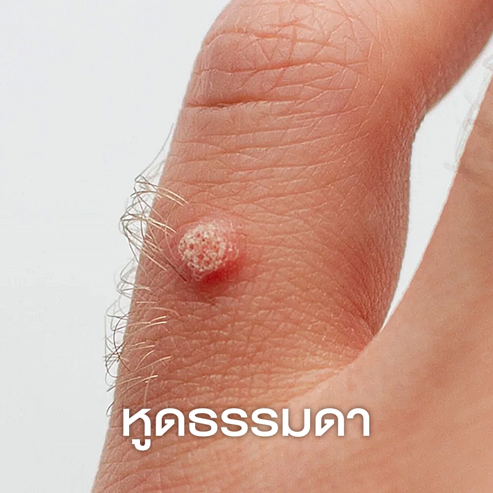 หูดธรรมดา (Common Warts _ Verruca Vulgaris)