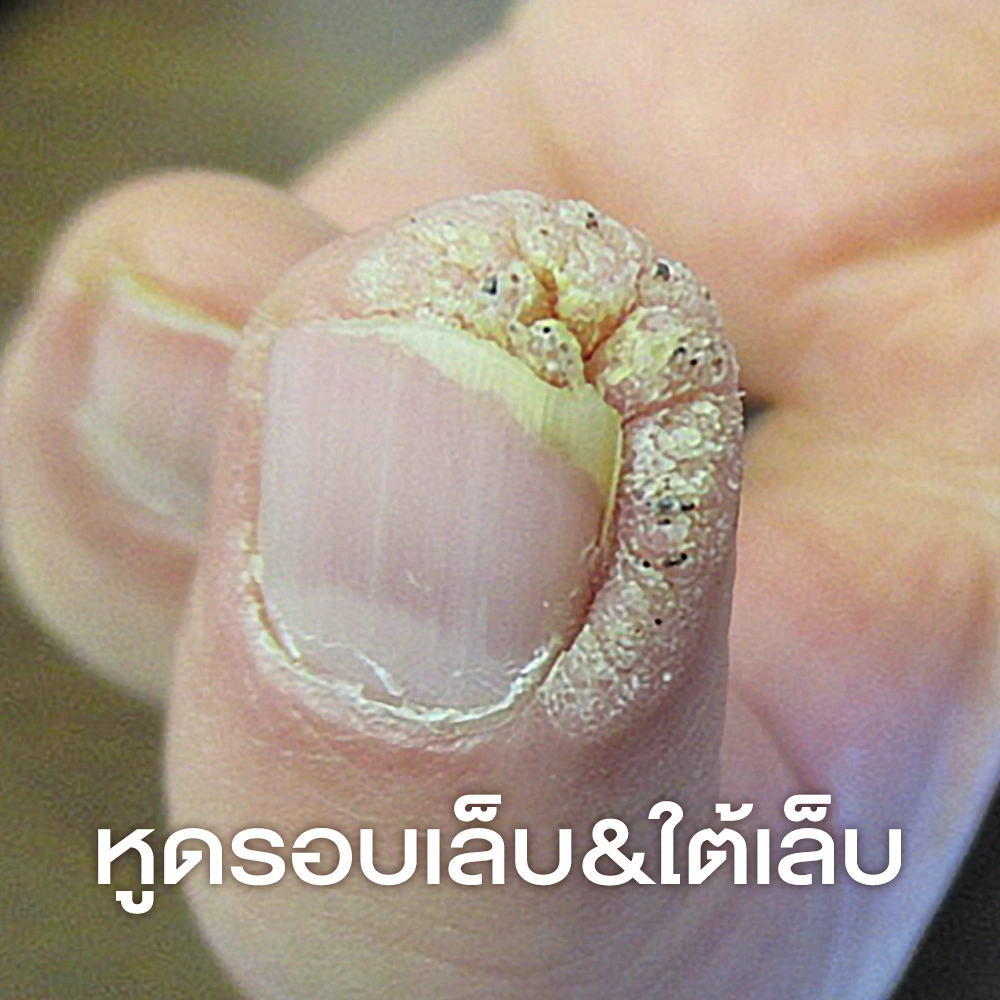 หูดรอบเล็บและใต้เล็บ (Periungual and Subungual Warts)