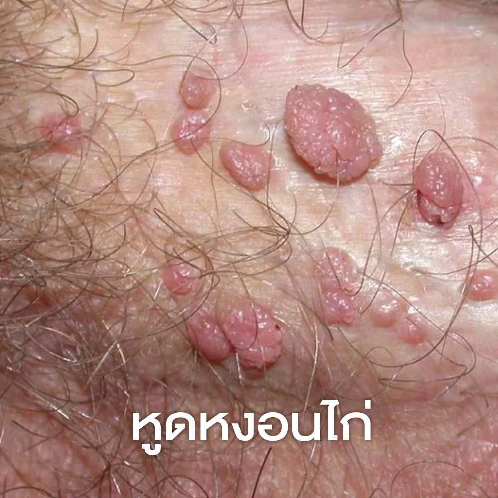 หูดหงอนไก่ หรือ หูดอวัยวะเพศ (Genital Warts _ Condyloma Acuminata)