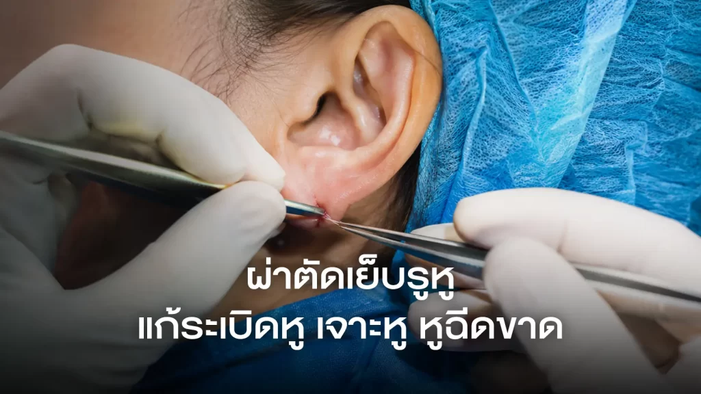 Cover-ผ่าตัดเย็บรูหู-แก้ระเบิดหู-เจาะหู