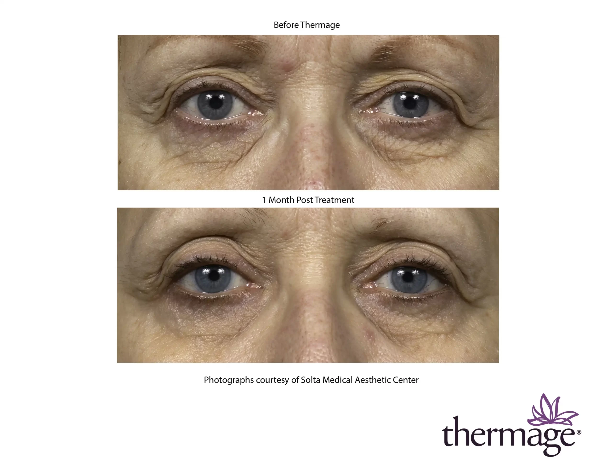 Thermage Before After SMAC_05