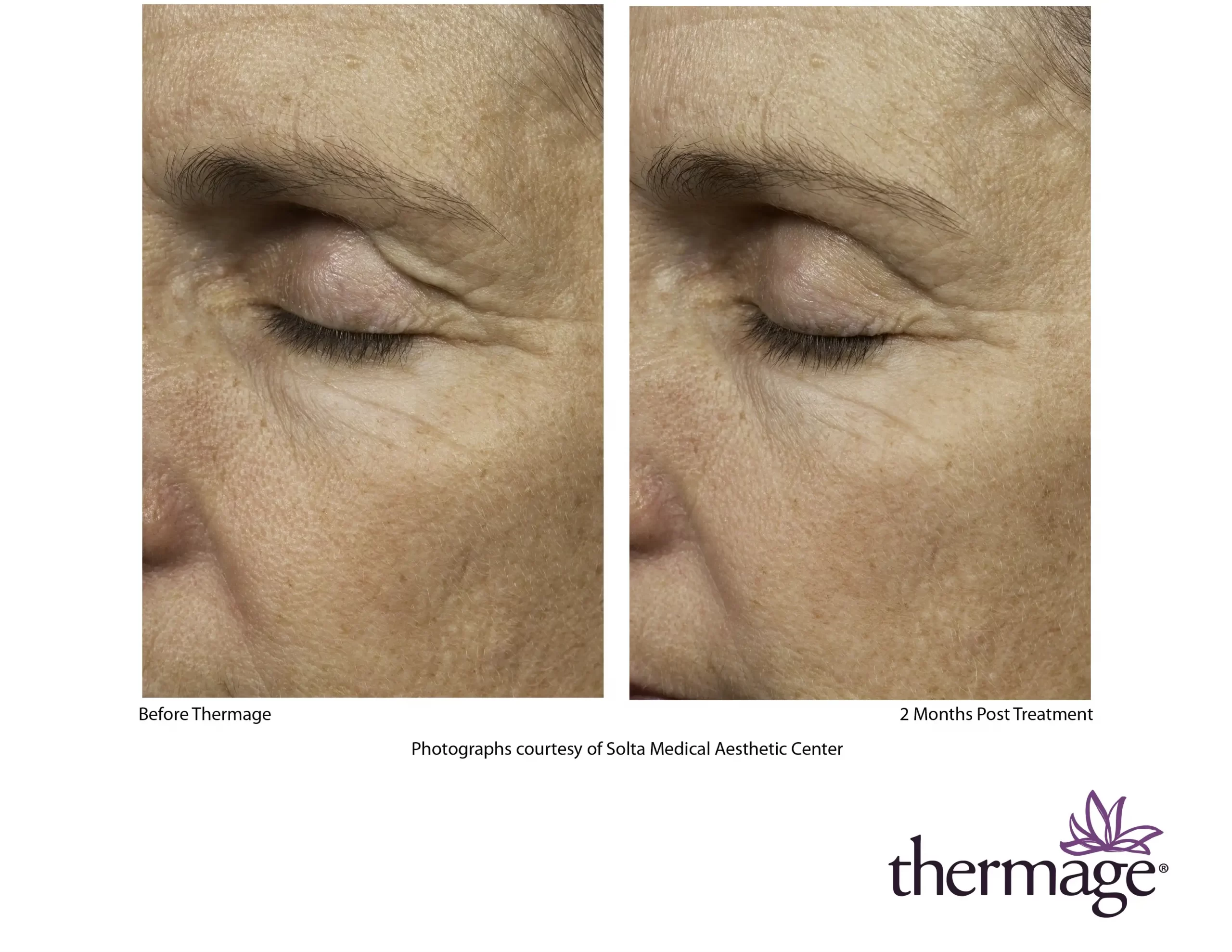 Thermage Before After SMAC_10