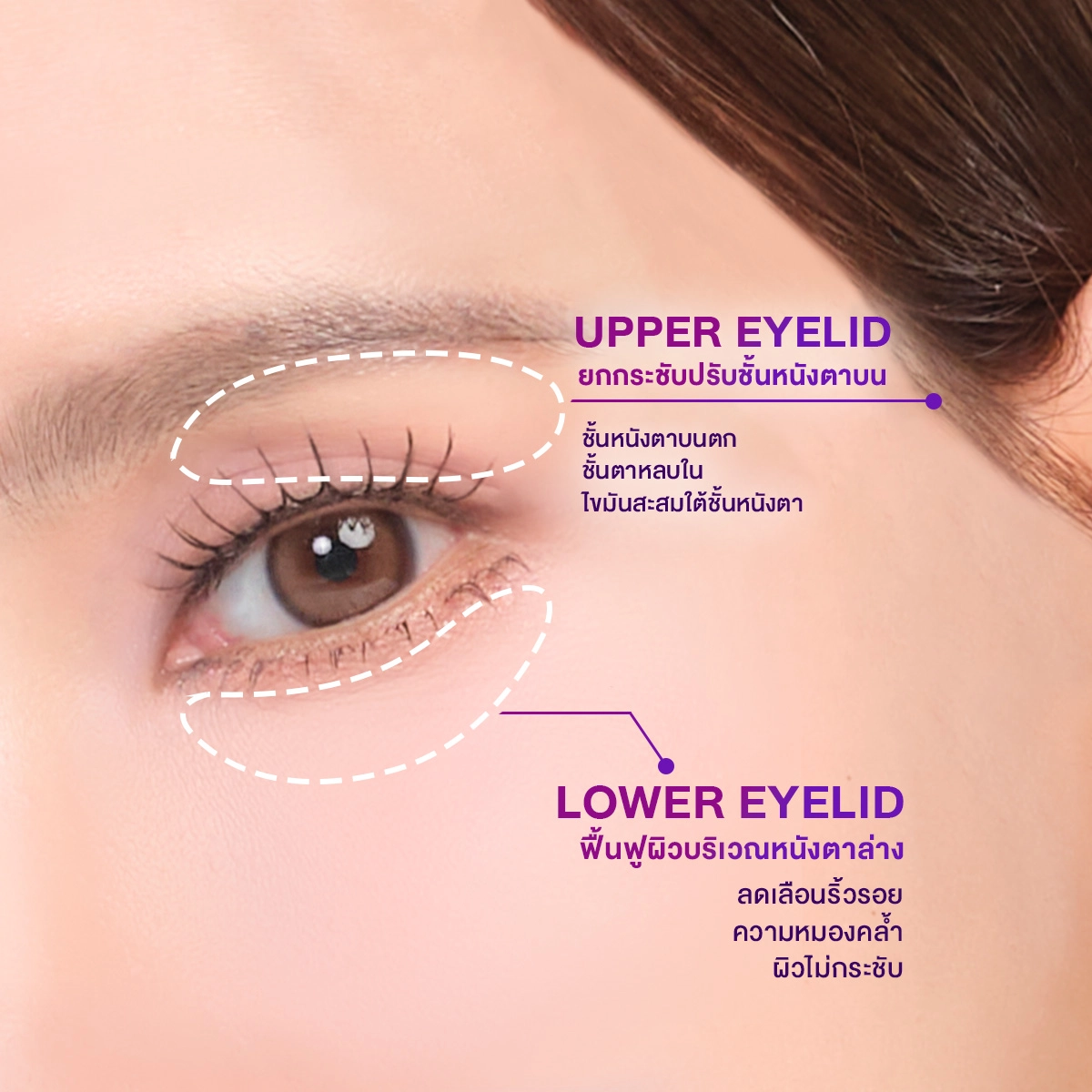Thermage-Eye-1